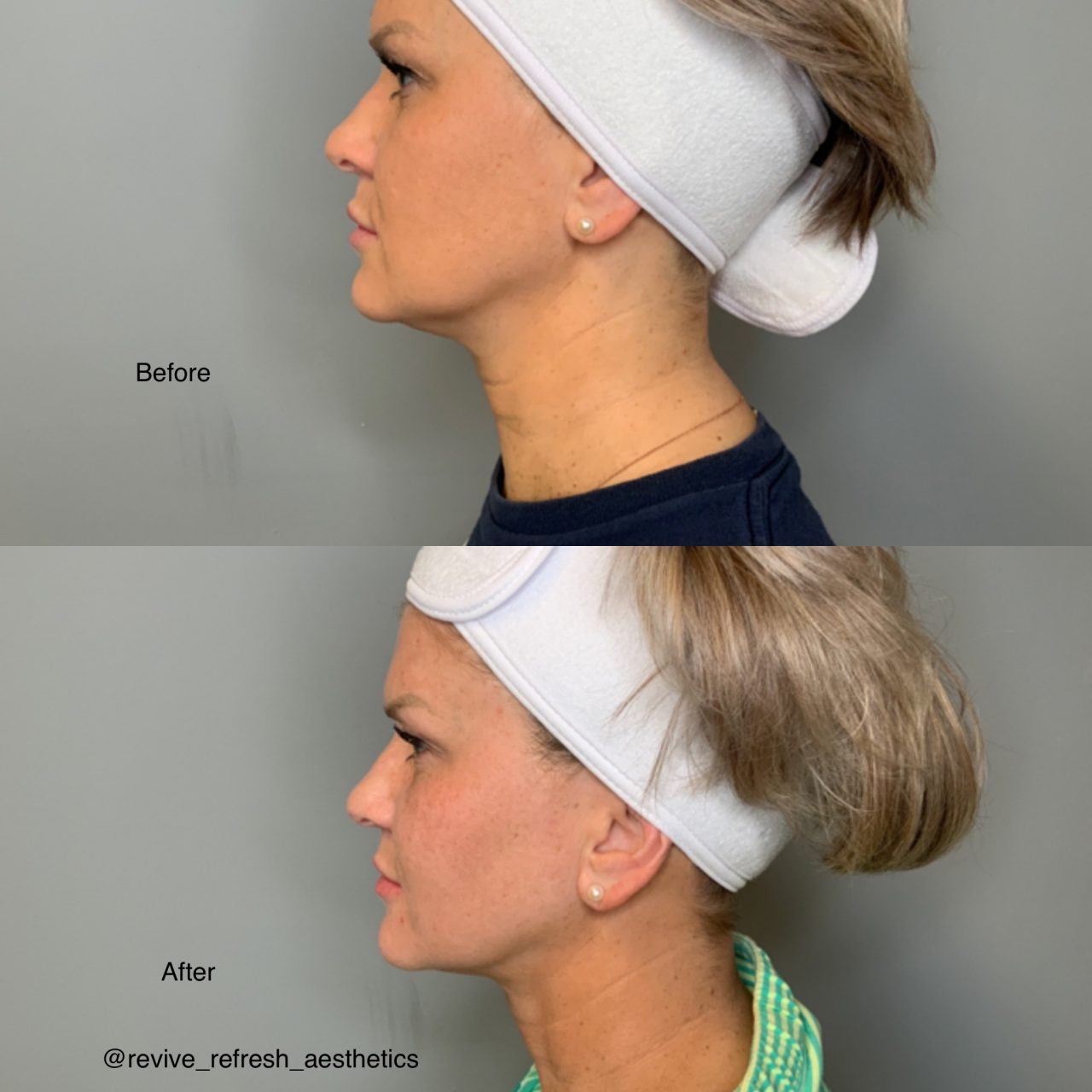 Fat Dissolving Injections Revive & Refresh