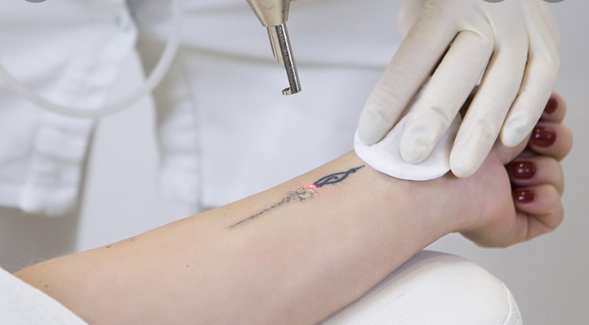 Treating Tattoo Removal - Atlantic Skin Care Dermatology Clinic, Nova Scotia